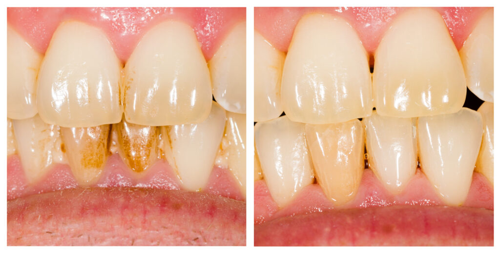 picture of before and after teeth with plaque 