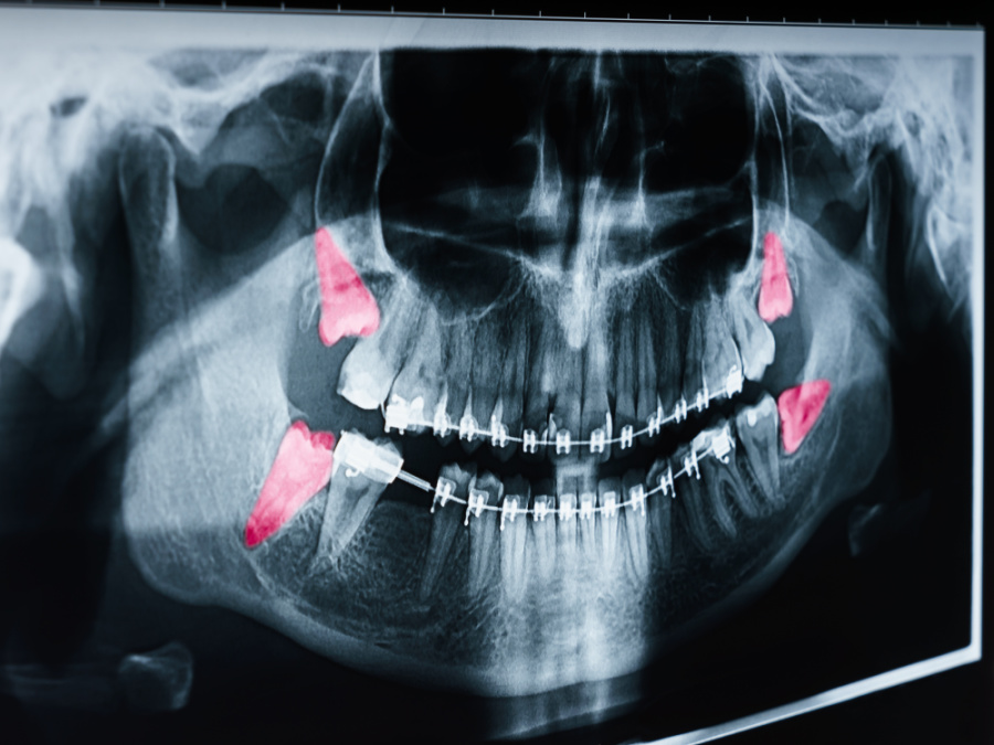 x-ray of wisdom teeth