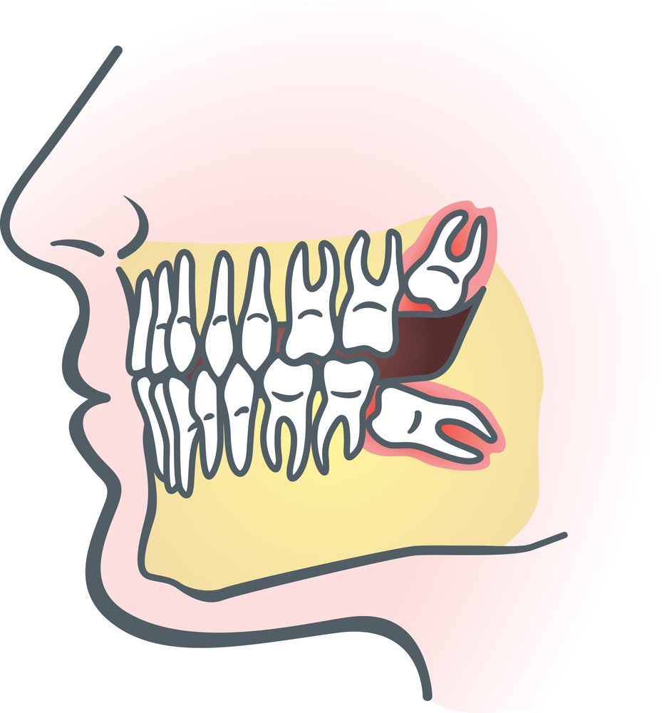 drawn illustration of wisdom teeth pain