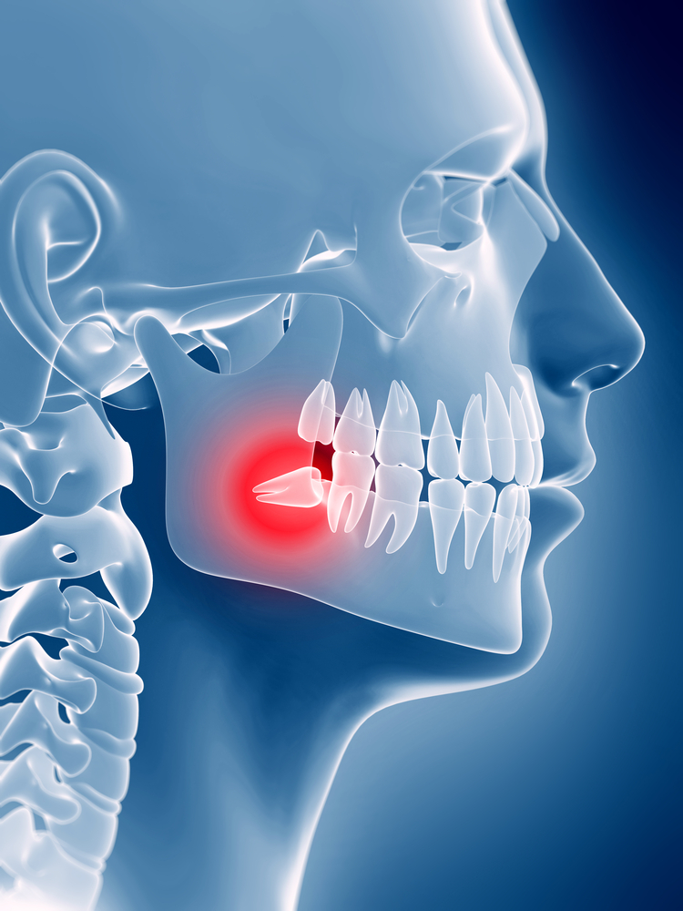 3D image of skill with wisdom teeth pain